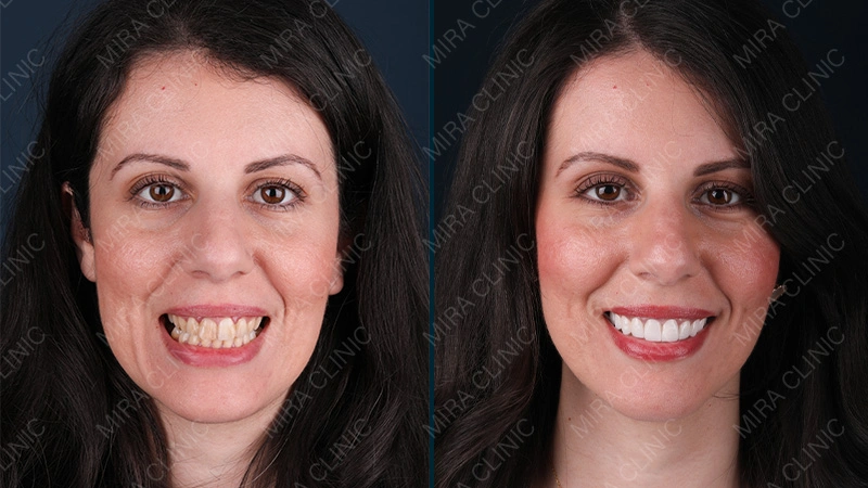 Hollywood smile before after